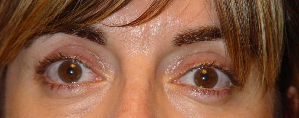 Cirugía cosmética palpebral (blefaroplastia)