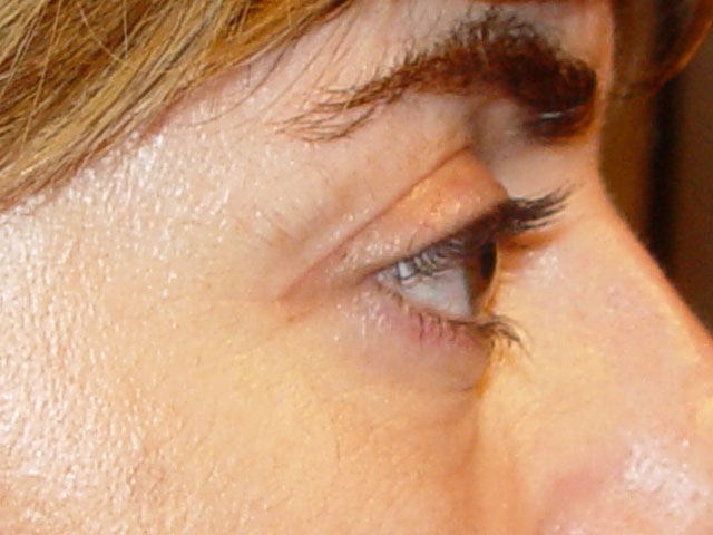 Cirugía cosmética palpebral (blefaroplastia)