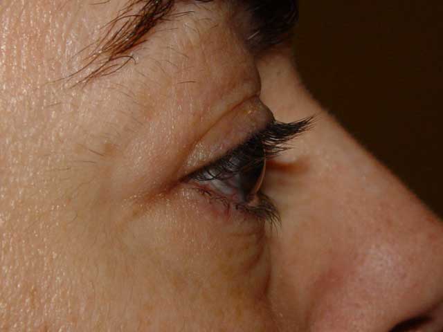 Cirugía cosmética palpebral (blefaroplastia)