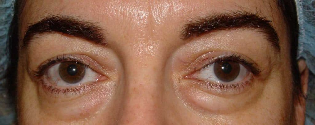 Cirugía cosmética palpebral (blefaroplastia)